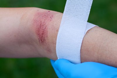 bigstock-Burned-Skin-71550982