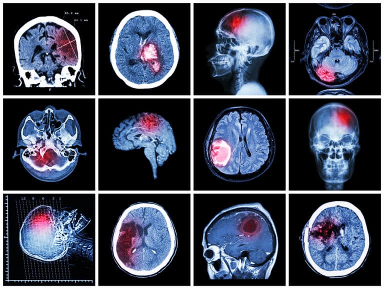 Common Brain Damage Test and Procedures for Brain Injuries