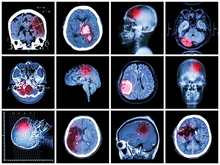 Common Test and Procedures for Brain Injuries