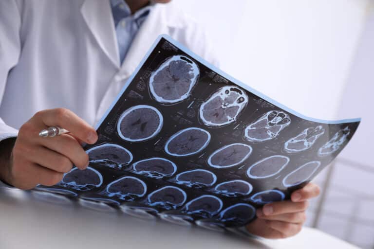 Brain Injuries in Car Accidents: Symptoms, Outcomes, and What to Do Next